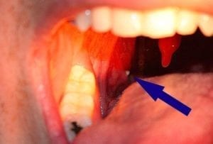 tonsillolit - pil som visar, var man hittar det: i halsmandelvecket bak i halsen