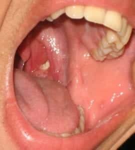 tonsillolit - hur det ser ut, vit boll bak i halsmandelvecket bak i halsen